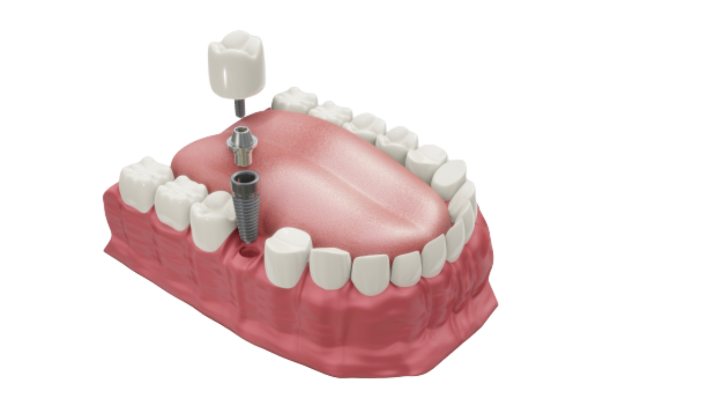 dental-implants-treatment-procedure-medically-accurate-3d-illustration-dentures-concept-removebg-preview