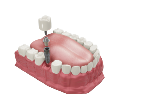 dental-implants-treatment-procedure-medically-accurate-3d-illustration-dentures-concept-removebg-preview